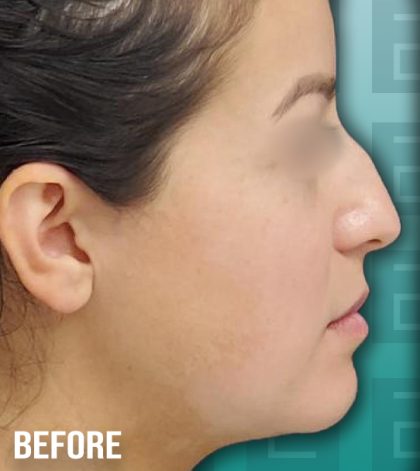 Rhinoplasty Before & After Patient #4178