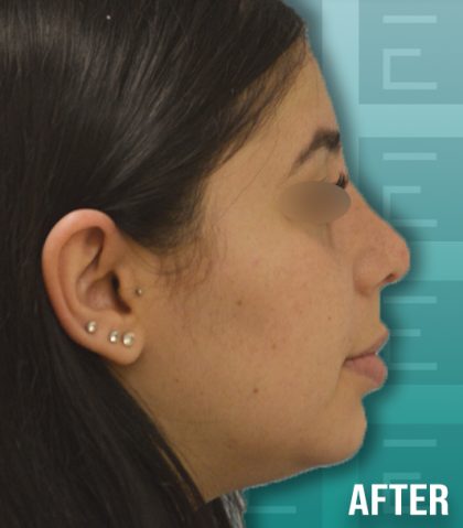 Rhinoplasty Before & After Patient #4201