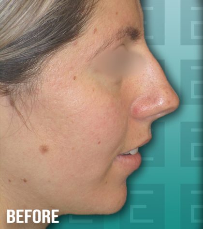 Rhinoplasty Before & After Patient #4167