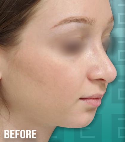 Rhinoplasty Before & After Patient #4168