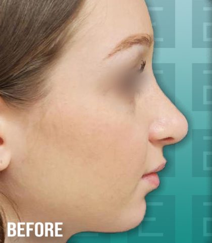 Rhinoplasty Before & After Patient #4168