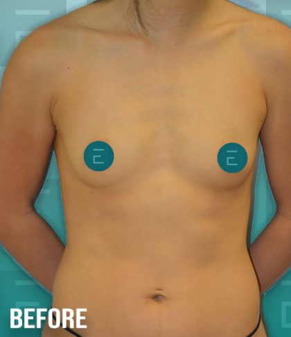 Breast Augmentation Before & After Patient #4155