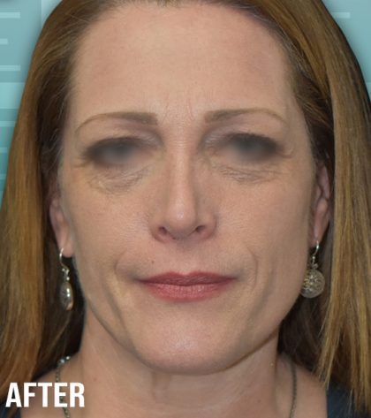 Rhinoplasty Before & After Patient #4173