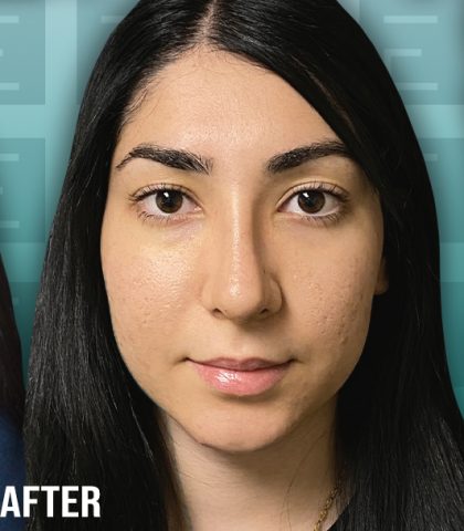 Rhinoplasty Before & After Patient #4174