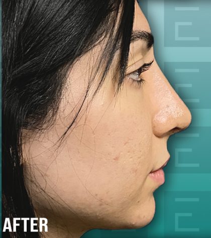 Rhinoplasty Before & After Patient #4175