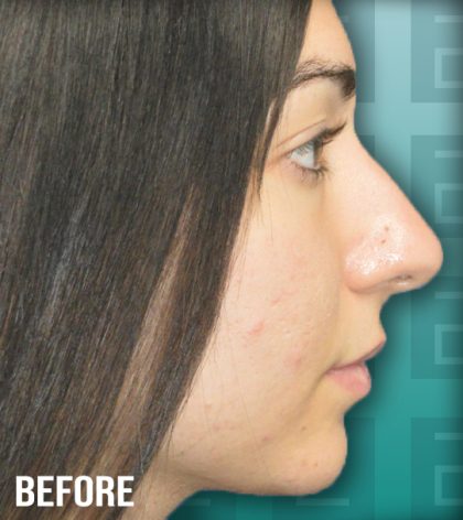 Rhinoplasty Before & After Patient #4175