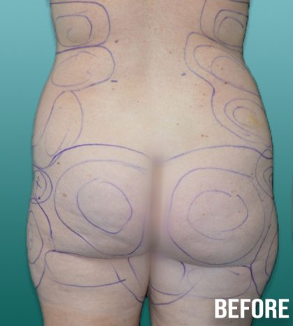 Liposuction Before & After Patient #4253