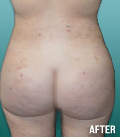 Liposuction Before & After Patient #4253