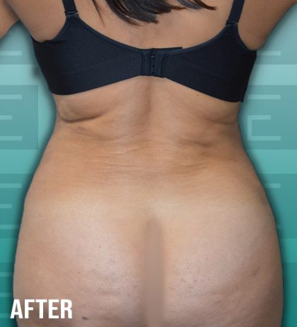 Liposuction Before & After Patient #4194