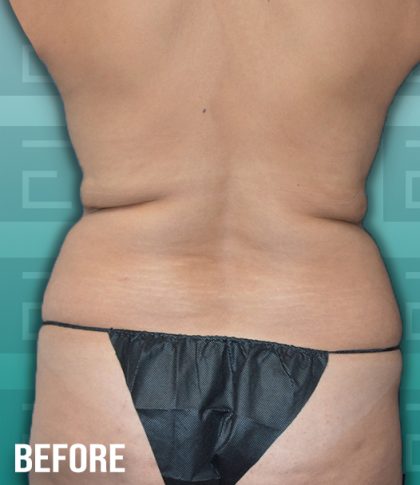 Liposuction Before & After Patient #4194