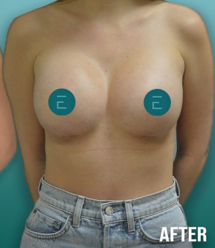 Breast Augmentation Before & After Patient #4254