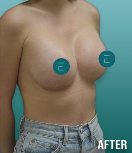 Breast Augmentation Before & After Patient #4254