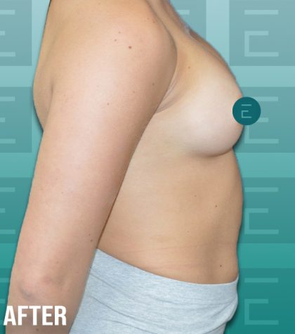 Breast Augmentation Before & After Patient #4156