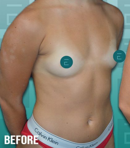 Breast Augmentation Before & After Patient #4156