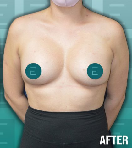Breast Augmentation Before & After Patient #4157