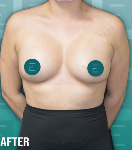 Breast Augmentation Before & After Patient #4157