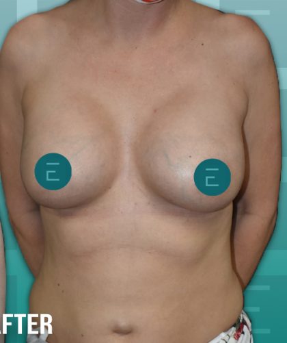 Breast Augmentation Before & After Patient #4158