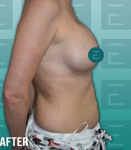 Breast Augmentation Before & After Patient #4158
