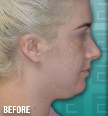 Chin Lipo Before & After Patient #4163