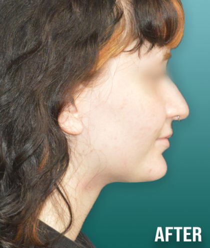 Chin Lipo Before & After Patient #4256