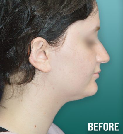 Chin Lipo Before & After Patient #4256
