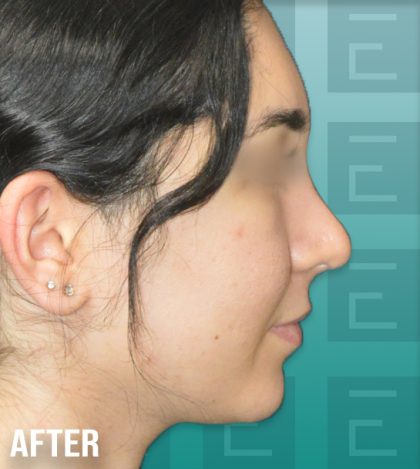 Rhinoplasty Before & After Patient #4179