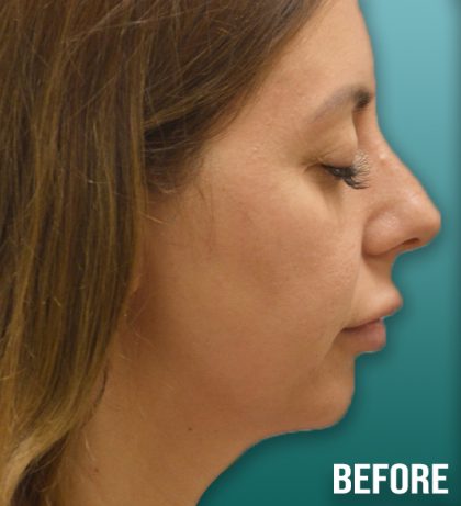 Rhinoplasty Before & After Patient #4259