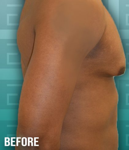 Gynecomastia Before & After Patient #4189