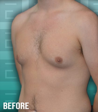 Gynecomastia Before & After Patient #4200