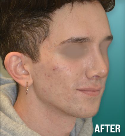 Rhinoplasty Before & After Patient #4260