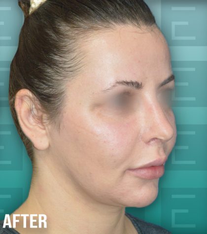 Rhinoplasty Before & After Patient #4180