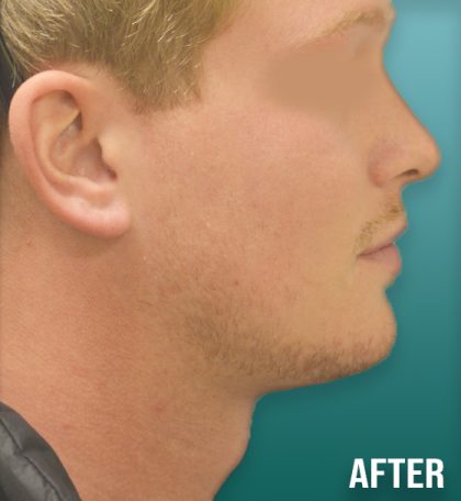 Chin Lipo Before & After Patient #4257