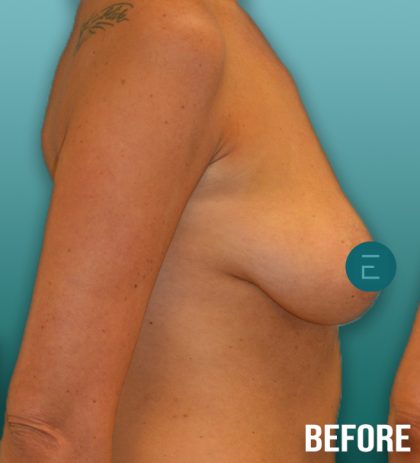 Breast Augmentation Before & After Patient #4255