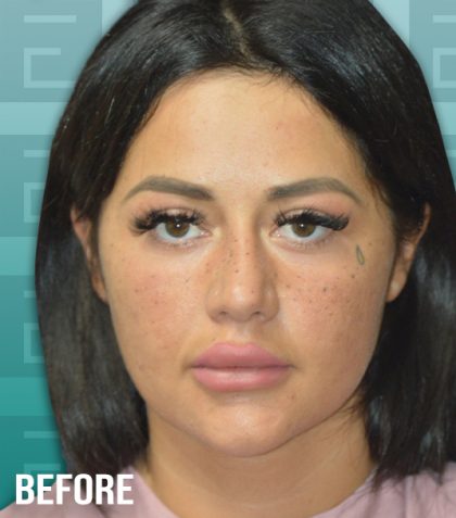 Rhinoplasty Before & After Patient #4181