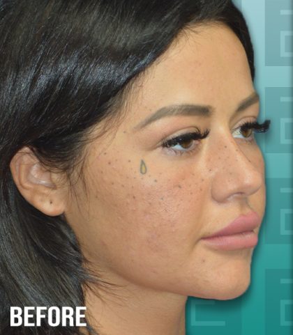 Rhinoplasty Before & After Patient #4181