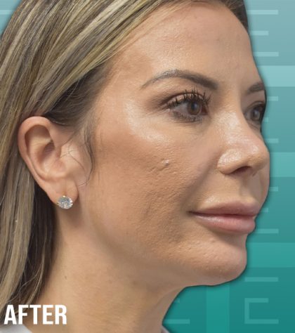 Rhinoplasty Before & After Patient #4182