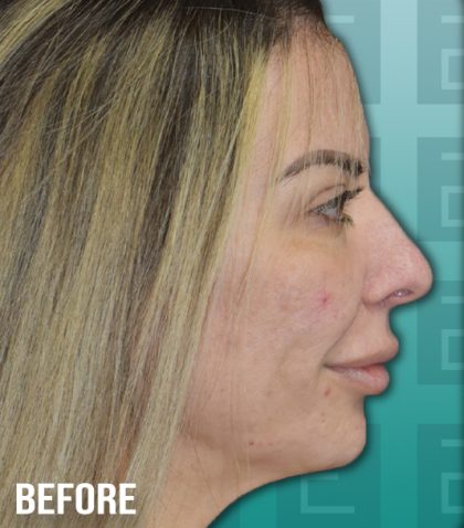 Rhinoplasty Before & After Patient #4182