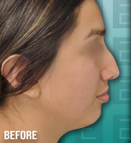 Rhinoplasty Before & After Patient #4185