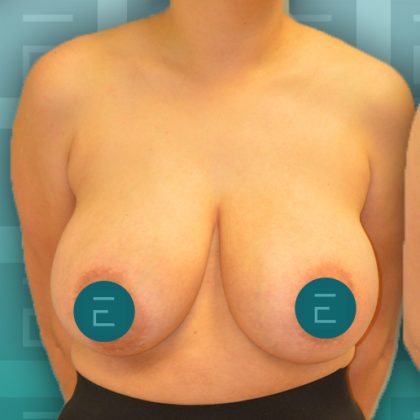 Breast Augmentation Before & After Patient #4159