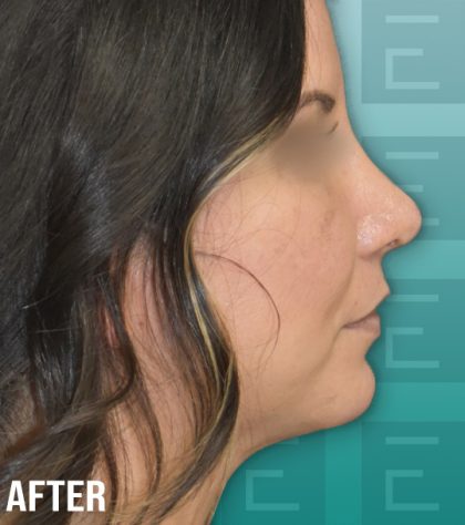 Rhinoplasty Before & After Patient #4186