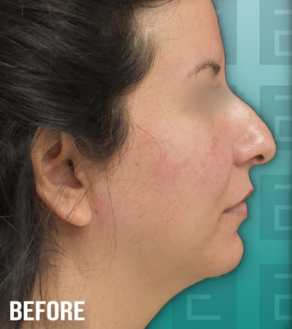 Rhinoplasty Before & After Patient #4186