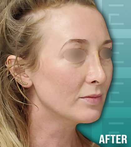 Rhinoplasty Before & After Patient #4187