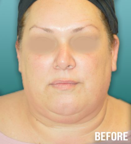 Chin Lipo Before & After Patient #4258