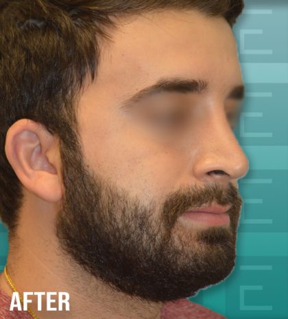 Rhinoplasty Before & After Patient #4261