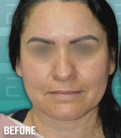 Rhinoplasty Before & After Patient #4199