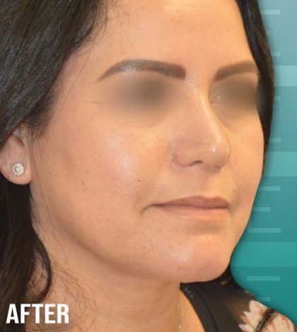 Rhinoplasty Before & After Patient #4199