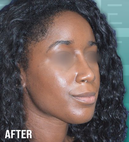 Rhinoplasty Before & After Patient #4202