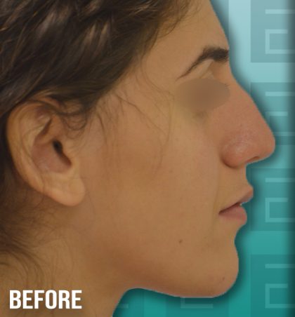 Rhinoplasty Before & After Patient #4203