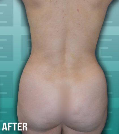 Liposuction Before & After Patient #4195