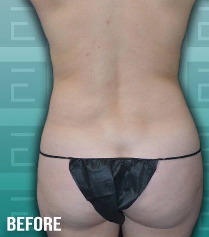Liposuction Before & After Patient #4195